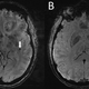 On the left, an arrow points to cerebral microbleeds captured in the left temporal lobe in a migraine case with aura. On the right, the arrow points to another possible abnormality on the same side of the microbleeds.